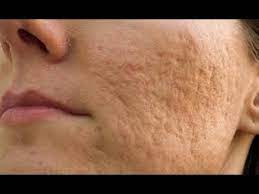 Sebab cara ini tidak seperti laser yang bisa merusak pigmen kulit, proses ini tidak memanaskan jaringan kulit. Cara Hilangkan Parut Jerawat Berlubang Dengan Berkesan