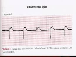 A pt with h/o of htn, dyslipidemia and cad is scheduled for surgery. Interpretation And Management Of The Ecg In Bradyarrhythmias And Heart Blocks Dr Tareq M Al Muflehi Interventional Cardiologist Ppt Video Online Download