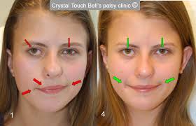 It results from dysfunction of cranial nerve vii (facial nerve) which directs the. Crystal Touch Bell S Palsy Clinic On Twitter A Touching Story Of Recovery From Aline The Video Tells Aline S Story And Her Parents Reaction To Her Recovery Aline Came To Us From Brazil