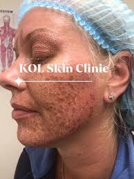 Fibroblast Plasma SPMU Aesthetics Professionals Only International