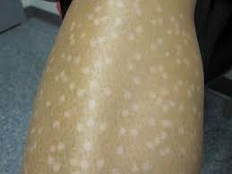 Burns, permanent changes to your skin color, and scars can occur. Laser Burns By Inexperienced Practitioners Be Careful Out There Toronto Dermatology Centre