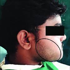 Exemplar histology of the commonest malignant odontogenic tumours....