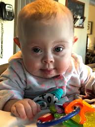 Down syndrome — Save Down Syndrome