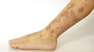 Image result for Eczema nummulare