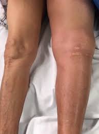 Collection by sadaf naz • last updated 8 weeks ago. Trombosis Venosa Profunda Dr Armando Romero