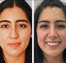 Trabajo de la Dra @dra_berenice_lobato. Tenemos a los mejores cirujanos y  los mejores resultados. . . . . . #nariz #rinoplastia #acidohialuronico  #lucelamejorversiondeti #lineasdeexpresion #botox #beautycare #cara  #saludybelleza #makeuptutorial #lips ...