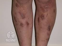 Image result for allergy rash on the legs