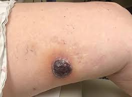 In the united states, it's estimated that doctors diagnose over 100,000 new skin cancer cases each year. 76 Year Old Woman With A Bluish Purple Lump In Her Left Upper Medial Leg
