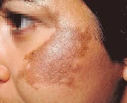 Therefore it's very important to encourage you that it's possible to find help to treat your melasma, because you are not alone with this issue. Ayurvedic Cure For Melasma Ayurveda