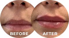 Skin perfect medical aesthetics is located in walnut, california. Top Medical Spa Los Angeles Orange County Skin Perfect Medical