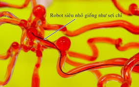 Robot siêu nhỏ giúp loại bỏ cục máu đông trong não