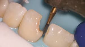 Since most cavities in children and adolescents develop in the molars (the back teeth), it's best to get these teeth sealed as soon as they come in: Teeth Bonding Front Tooth Filling Explained Youtube