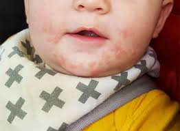 Image result for red rash face
