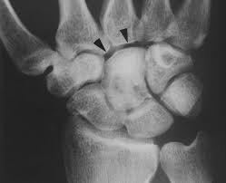 Image result for Capitate Bone