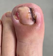 Image result for Onychotillomania feet