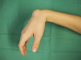 Ganglion Uberbein Ordination Dr Kitzinger