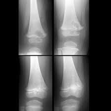 Image result for Osteomyelitis XRay