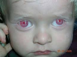 Albino Child With Red Eyes Albino Human Albino Albinism