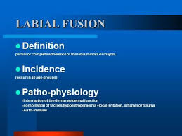 Image result for Labial Fusion