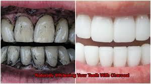 Naturally Whitening Your Teeth With Charcoal
