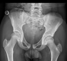 Misdiagnosis of this injury can lead to permanent nerve damage, as well as. Pelvic Avulsion Injuries