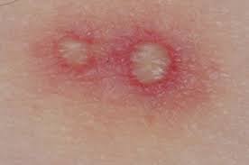 Image result for Fire Ant Sting