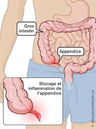 Ainsi que des témoignages d'internautes. Appendicite