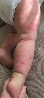 Order picrnovirales family picornaviridae genus aphthovirus species bovine rhinitis virus. Atypical Hand Foot And Mouth Disease Pediatrics