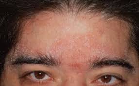Image result for Seborrheic Dermatitis