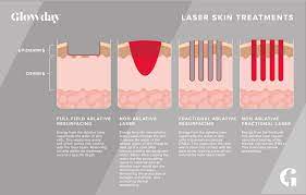 The treatment eliminates old epidermal pigmented cells and deposits heat deep into the dermis to tighten skin and stimulate collagen remodeling. Ablative Laser Resurfacing Glowday