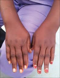 Sequelae Of Ebola Virus Disease The Emergency Within The Emergency The Lancet Infectious Diseases