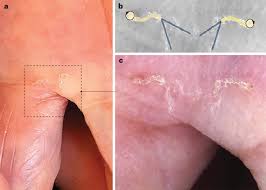 Image result for scabies effects on the human body