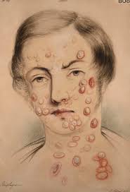 Image result for Pemphigus