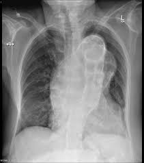 Horacic Aneurysms Are Often Identified Incidentally On Imaging Of The Chest A Symptomatic Presentation May Be D Radiology Radiology Imaging Diagnostic Imaging