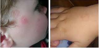 Boala lyme poate fi tratată dacă este defecționată, dar fără tratament, poate. Afla Cum Poti Depista Repede Boala Lyme O Mama Tocmai A Salvat Viata Fiului Sau Aktual24