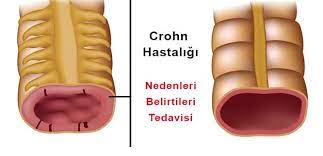 İstisna, son hastalığın en ciddi vakalarıdır. Crohn Hastaligi Nedir Neden Olur Belirtileri Ve Tedavisi