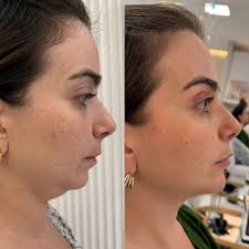 Franciely Follmann Boniatti| Harmonização Facial (@dra.franfollmann) •  Instagram फोटोहरू र भिडियोहरू