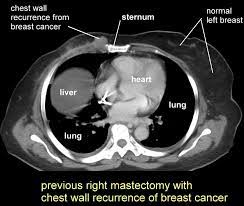 The scan is painless and takes about 10 to 30 minutes. Breast Mass Found On Ct Scan Ct Scan Machine