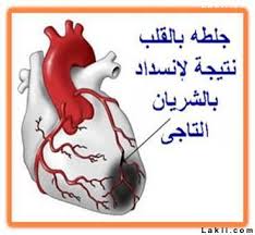 مرض السكري