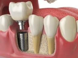 For example, getting a tooth pulled can cost anywhere between $50 and $900 … take all of this into account and you can understand why getting dentures can. After A Tooth Extraction How Long Until You Can Get A Dental Implant
