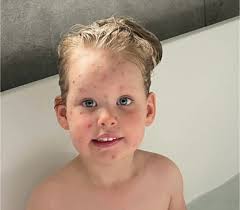 Abbey Hunt “Hello I just thought you might like to see my daughters results  from having horrendous chickenpox and using your green cream. Won't lie she  was a trooper though the whole