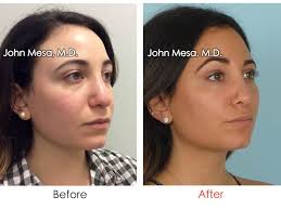 Bichectomy surgery, also known as the hollywood cheek, allows the patient to return to his daily life almost immediately, as the operation time is short and the skin does not require external intervention. Buccal Fat Removal Nyc Buccal Fat Removal Nyc By Dr Mesa Colombian Plastic Surgeon Nyc