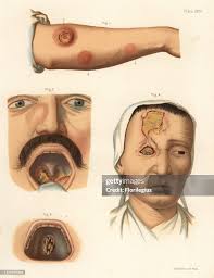 Image result for Tertiary Syphilis