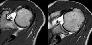 Image result for Shoulder MRI
