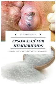 Epsom Salt For Hemorrhoids Relief What You Need To Know About Epsom Salts And Hemorrhoids Hemorrhoids Hemorrhoid Remedies Home Remedies For Hemorrhoids