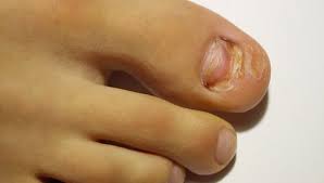If you lose only part of your toenail, it may grow back quicker. A New Nail Grow Back Stock Footage Video 100 Royalty Free 12634193 Shutterstock