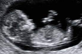 Is It Ok To Use A Hot Tub During Early Pregnancy Your Pregnancy Matters Ut Southwestern Medical Center