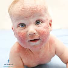 Image result for Atopic Dermatitis