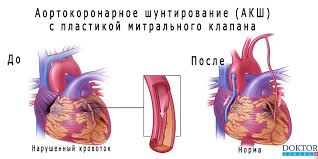 Aortokoronarnoe Shuntirovanie V Izraile Ceny Otzyvy Doktorisrael
