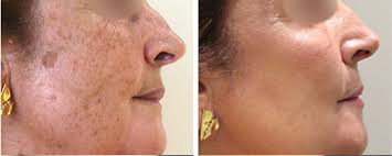 Laser Pigmentation Removal London Premier Laser Clinic
